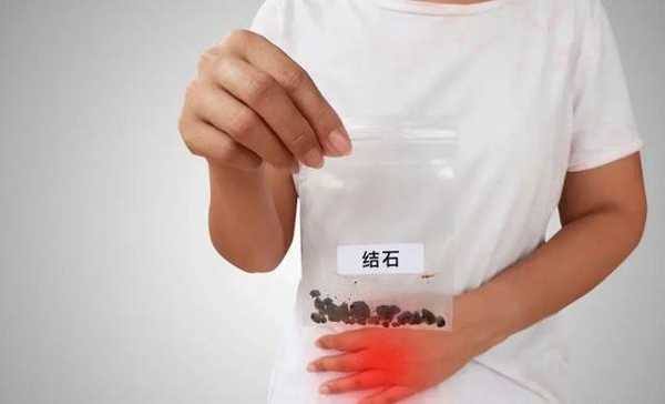 人体结石