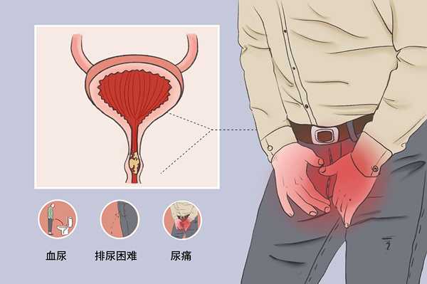 尿道结石