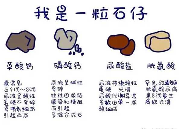 结石种类