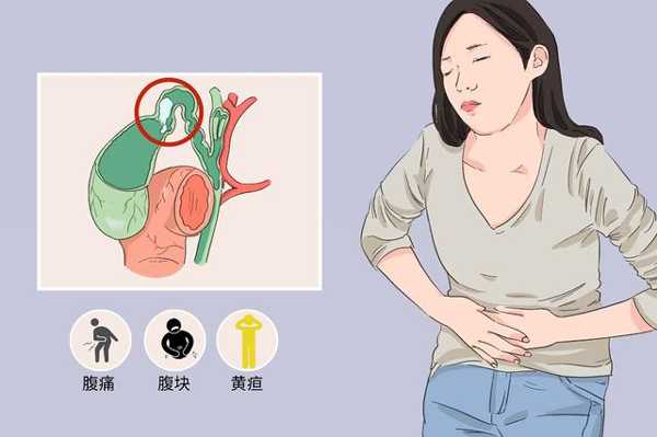 胆囊结石