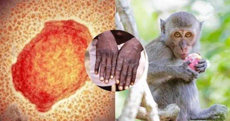 我国再现猴痘病毒感染病例，国家卫生健康委发布诊疗指南