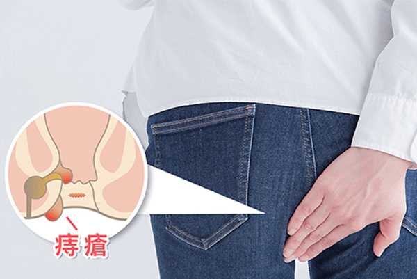远离痔疮，教你四招！