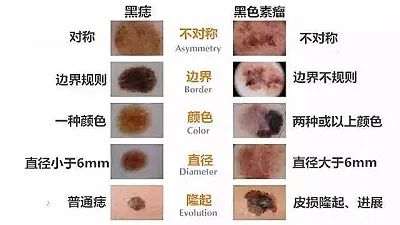 一文读懂黑色素瘤和正常黑痣的区别！