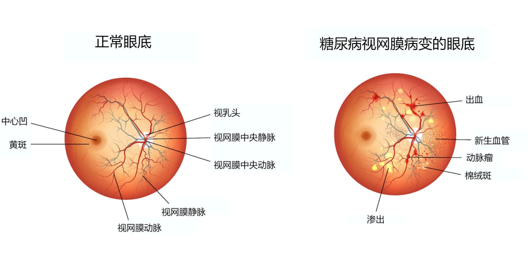 血糖控制不好，会对身体造成哪些危害？