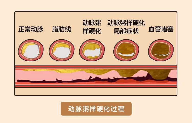 血管硬化不可逆，预防血管硬化需要注意以下事项！