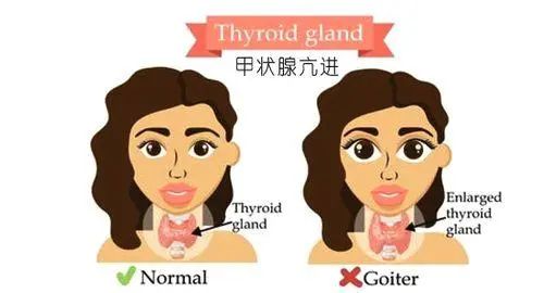 浅谈全飞秒激光近视手术