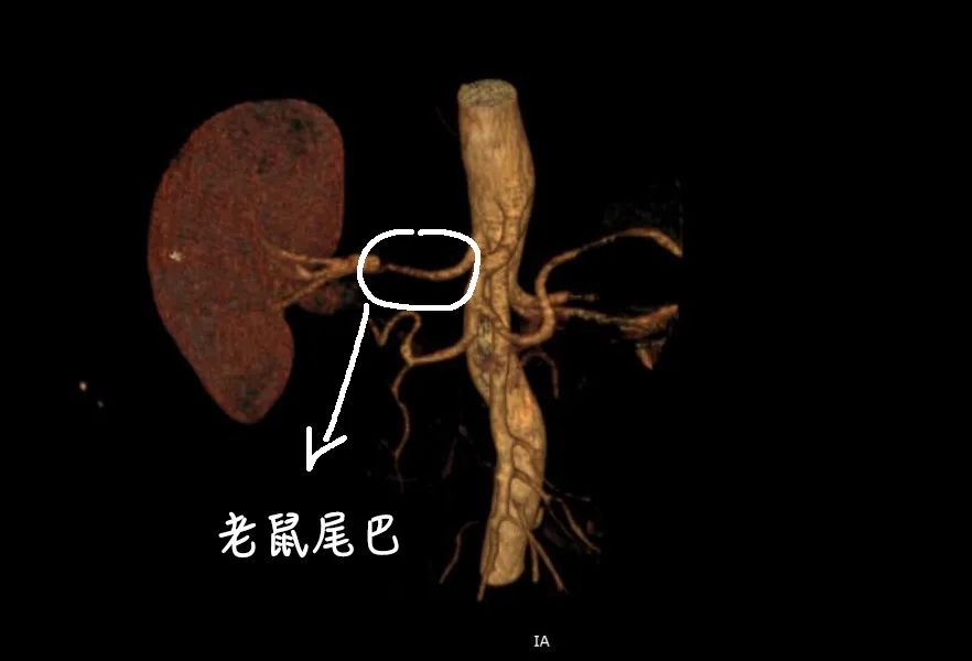 男人肾不行，更容易得高血压！关注肾血管性高血压症