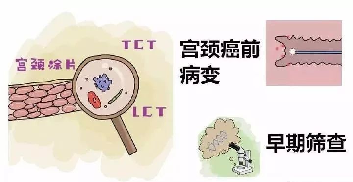 如何在早期发现宫颈癌？