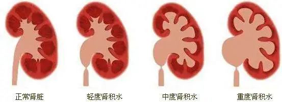 得了肾结石怎么办！哪些药物能够治疗和预防肾结石？
