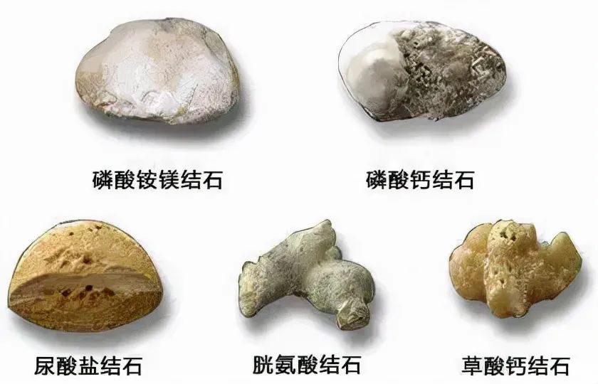 得了肾结石怎么办！哪些药物能够治疗和预防肾结石？