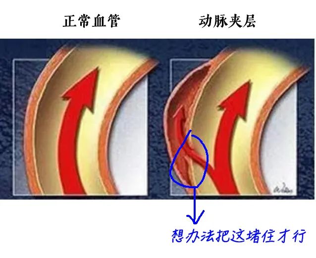 男人肾不行，更容易得高血压！关注肾血管性高血压症