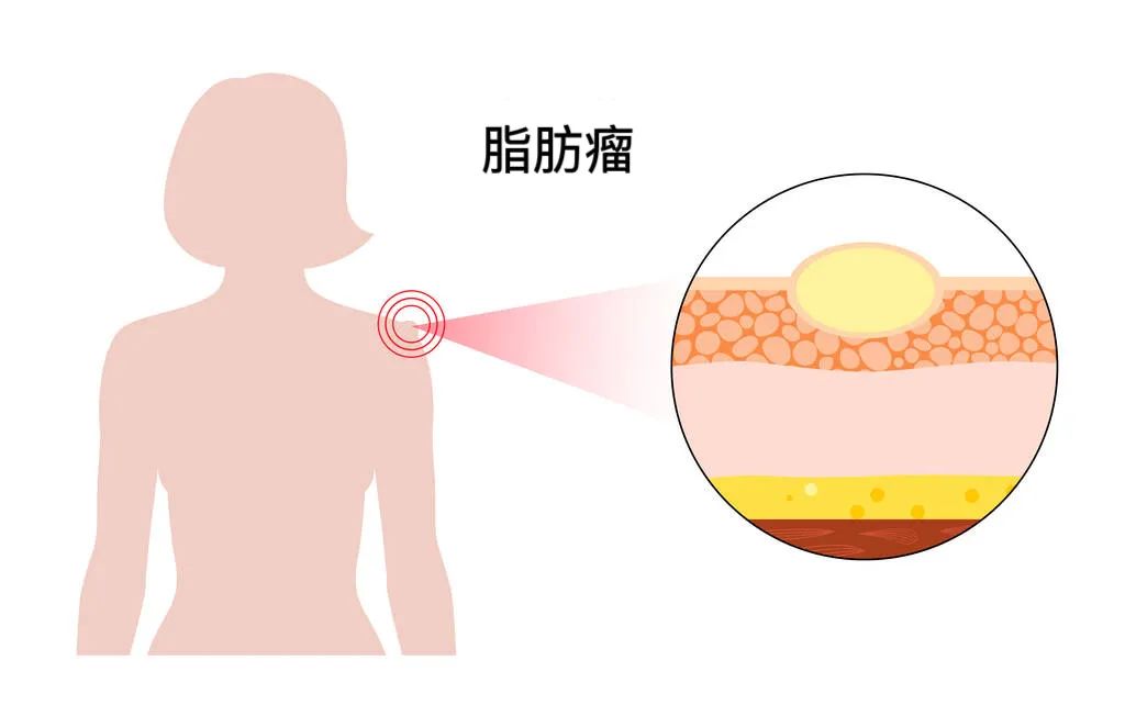 脂肪瘤不痛不痒，需要治疗吗？脂肪瘤怎么治疗最好？