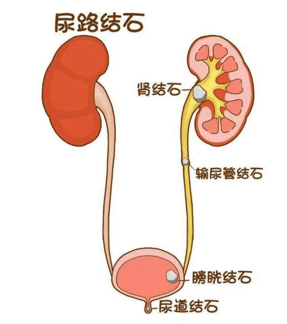 得了肾结石怎么办！哪些药物能够治疗和预防肾结石？