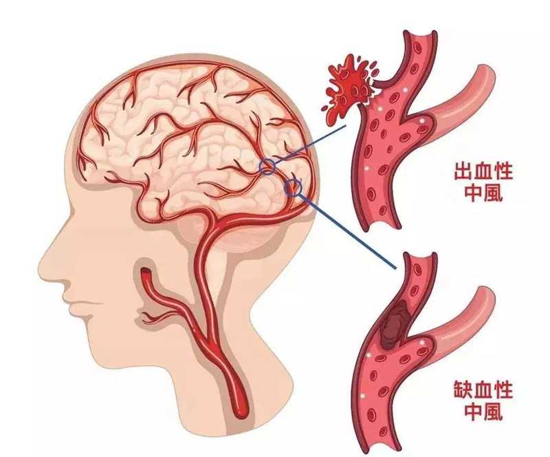 预防脑梗塞，建议检查颈动脉彩超和心电图！