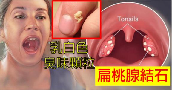 无法改善的口臭、咽喉痛，需要检查一下你的扁桃体结石！